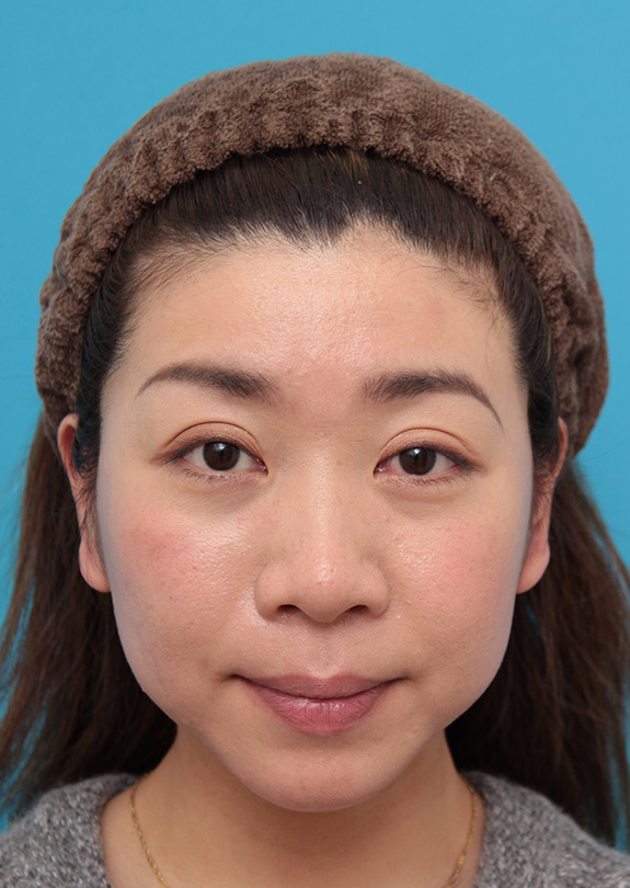 症例写真,二重まぶた・全切開法 もとの二重より少し幅を広げた平行型にした症例,After(6ヶ月後)<br/>
(メイクあり),