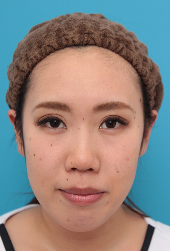 症例写真,二重まぶた・全切開法 蒙古ひだを超えて平行型になるようにした症例,After(6ヶ月後)<br/>
(メイクあり),