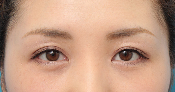 症例写真,目頭切開で、平行型二重のまま目を内側に広げた症例写真,After(6ヶ月後メイクあり),