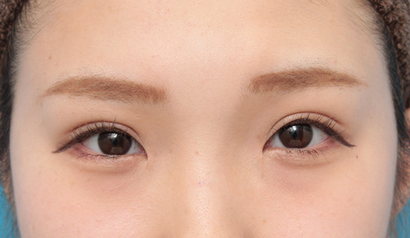 眼瞼下垂(がんけんかすい),目頭切開、眼瞼下垂手術、タレ目形成を同時に行った症例写真,After(6ヶ月後メイクあり),
