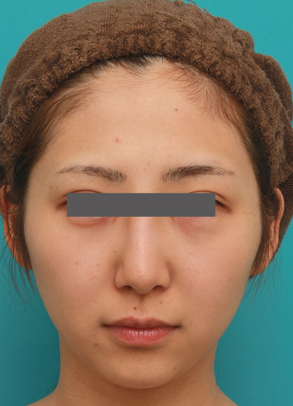 小顔専用脂肪溶解注射メソシェイプフェイスで小顔になった症例写真,After（5回目注射後3週間）,ba_meso_face006_a01.jpg