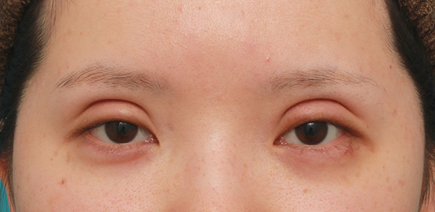 二重まぶた・ミニ切開法（部分切開）,患者様の希望で二重まぶたミニ切開法で幅の広い平行型二重を作った症例写真,6日後,目を開けた状態,mainpic_mini_sekkai041d.jpg