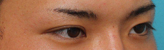 二重まぶた・埋没法,二重の埋没法で自然な末広型を作った症例写真,After(3ヶ月後),ba_maibotsu041_b03.jpg