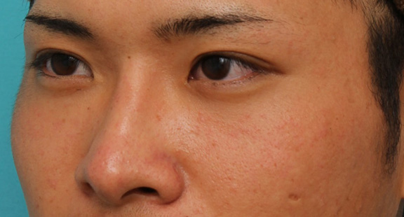 症例写真,長期持続型ヒアルロン酸により鼻を高くした症例写真,After(1ヶ月後),ba_ryubi2031_b02.jpg