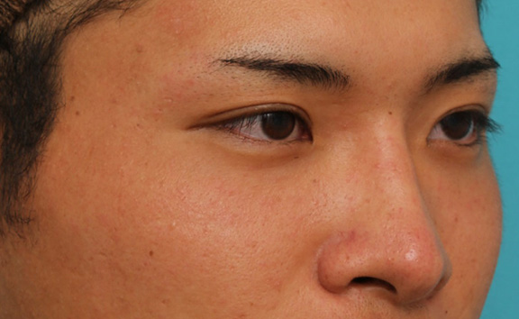 症例写真,長期持続型ヒアルロン酸により鼻を高くした症例写真,After(1ヶ月後),ba_ryubi2031_b03.jpg