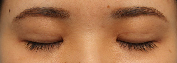 症例写真,全切開法で二重を作り、目頭切開で内側に広げた症例写真,After(7ヶ月後の目を閉じた状態),