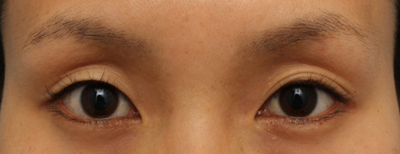 二重まぶた・埋没法,埋没法でナチュラルな平行二重を作った症例写真,Before,ba_maibotsu042_b01.jpg
