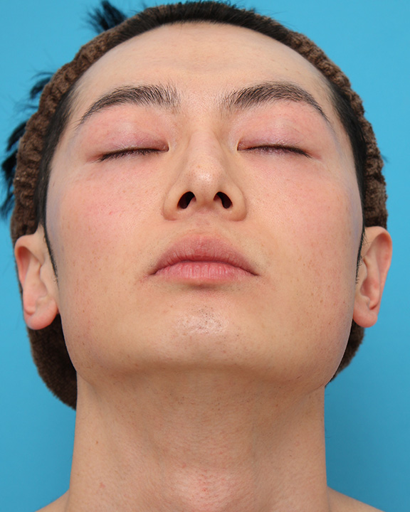 医療レーザー脱毛,男性の濃い髭をレーザー永久脱毛で薄くした症例写真,After(9回目レーザー照射後2ヶ月),ba_epi009_b02.jpg