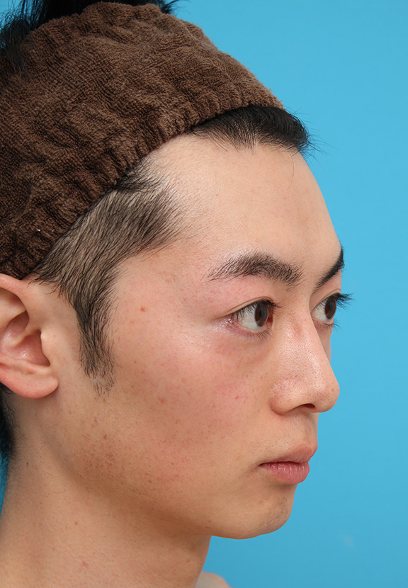 医療レーザー脱毛,男性の濃い髭をレーザー永久脱毛で薄くした症例写真,After(9回目レーザー照射後2ヶ月),ba_epi009_b03.jpg
