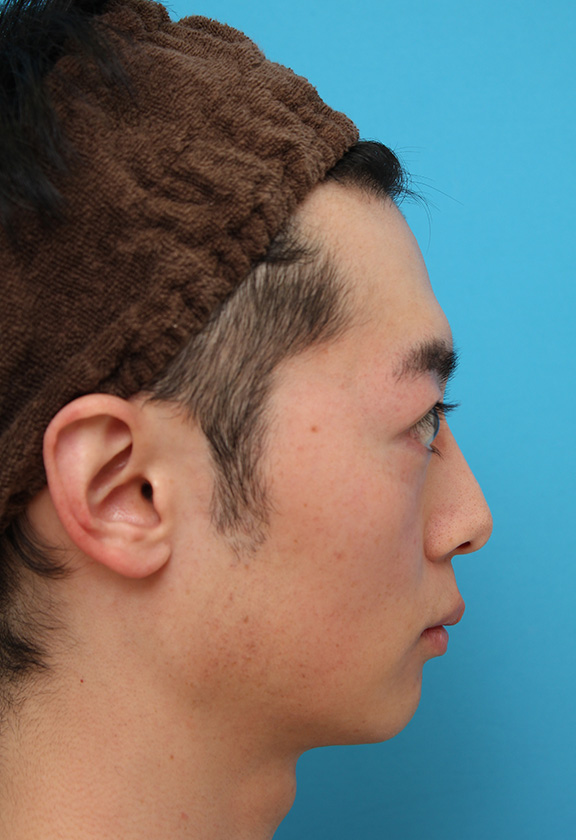 医療レーザー脱毛,男性の濃い髭をレーザー永久脱毛で薄くした症例写真,After(9回目レーザー照射後2ヶ月),ba_epi009_b04.jpg