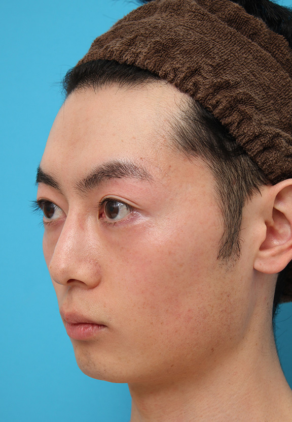 医療レーザー脱毛,男性の濃い髭をレーザー永久脱毛で薄くした症例写真,After(9回目レーザー照射後2ヶ月),ba_epi009_b05.jpg