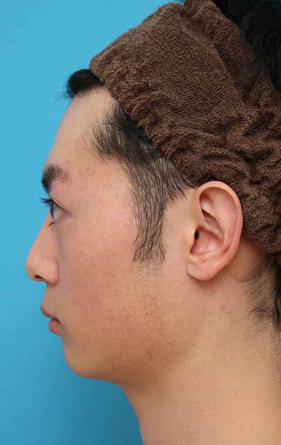 医療レーザー脱毛,男性の濃い髭をレーザー永久脱毛で薄くした症例写真,After(9回目レーザー照射後2ヶ月),ba_epi009_b06.jpg