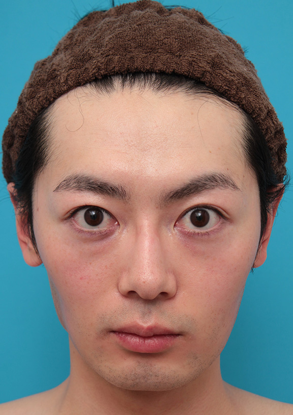 男性の濃い髭をレーザー永久脱毛で薄くした症例写真,Before,ba_epi009_b01.jpg