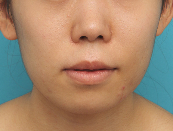 唇を薄く(口唇縮小術),上下の厚い唇を口唇縮小手術で薄くした症例写真,After(6ヶ月後),ba_usuku009_b02.jpg