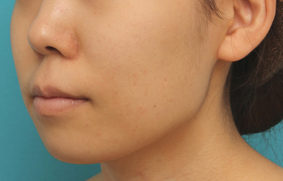 唇を薄く(口唇縮小術),上下の厚い唇を口唇縮小手術で薄くした症例写真,After(6ヶ月後),ba_usuku009_b03.jpg
