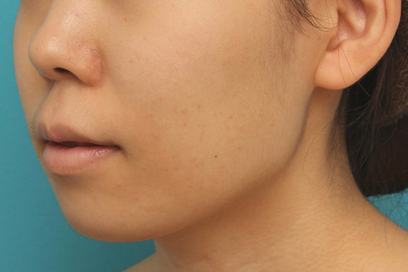 唇を薄く(口唇縮小術),上下の厚い唇を口唇縮小手術で薄くした症例写真,After(6ヶ月後),ba_usuku009_b04.jpg