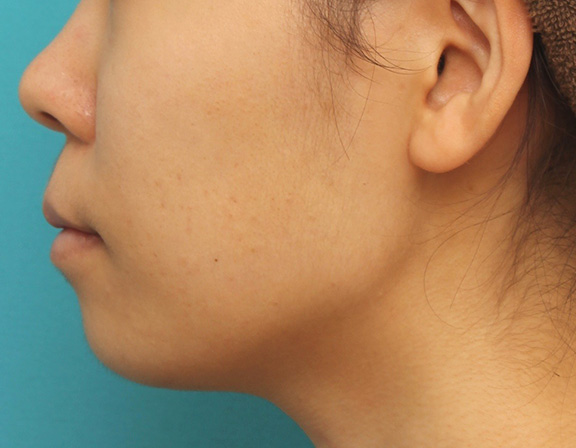 唇を薄く(口唇縮小術),上下の厚い唇を口唇縮小手術で薄くした症例写真,After(6ヶ月後),ba_usuku009_b05.jpg