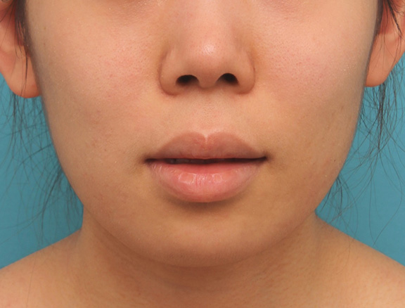 唇を薄く(口唇縮小術),上下の厚い唇を口唇縮小手術で薄くした症例写真,Before,ba_usuku009_b02.jpg