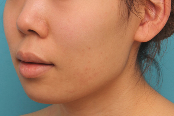 唇を薄く(口唇縮小術),上下の厚い唇を口唇縮小手術で薄くした症例写真,Before,ba_usuku009_b04.jpg