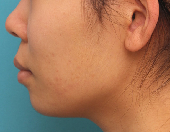唇を薄く(口唇縮小術),上下の厚い唇を口唇縮小手術で薄くした症例写真,Before,ba_usuku009_b05.jpg