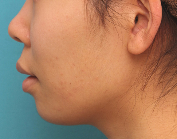 唇を薄く(口唇縮小術),上下の厚い唇を口唇縮小手術で薄くした症例写真,Before,ba_usuku009_b06.jpg