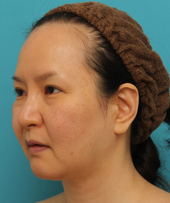 症例写真,顔の脂肪吸引をし、小顔になってたるみも改善した40代女性の症例写真,After(6ヶ月後),ba_shibo004_b02.jpg
