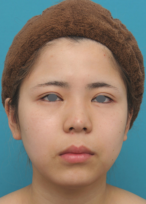 脂肪吸引（頬、あご下）,脂肪吸引,頬、顎下の脂肪吸引をし、下膨れの顔の輪郭が改善した症例写真,After（6ヶ月後）,ba_shibo005_a01.jpg