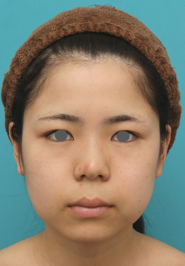 脂肪吸引（頬、あご下）,頬、顎下の脂肪吸引をし、下膨れの顔の輪郭が改善した症例写真,手術前,mainpic_shibo005a.jpg