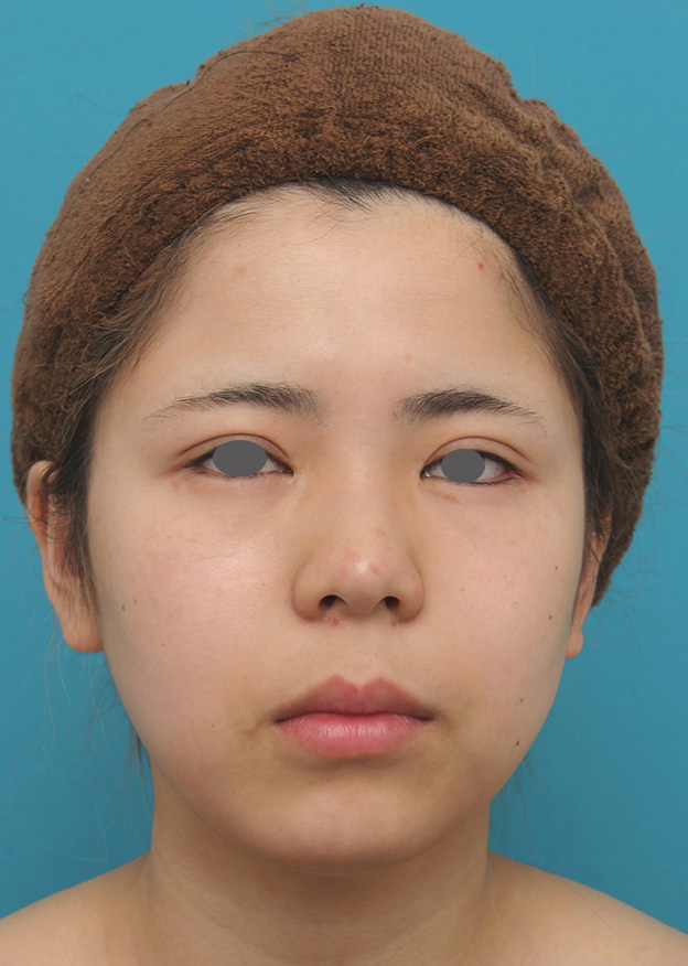 脂肪吸引（頬、あご下）,頬、顎下の脂肪吸引をし、下膨れの顔の輪郭が改善した症例写真,6ヶ月後,mainpic_shibo005d.jpg