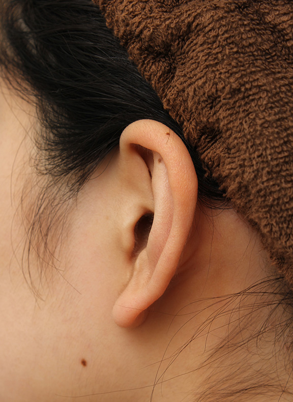 耳介軟骨移植(鼻先を出す),鼻先と鼻柱に耳介軟骨移植を行い、バランスを良くした症例写真,Before,ba_jikai044_b05.jpg
