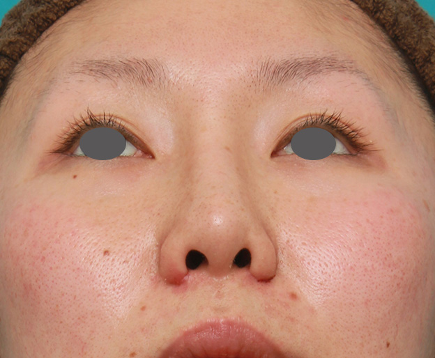 他院で受けた手術の修正(鼻),他院で受けた鼻の手術の修正(プロテーゼ入れ替え+耳介軟骨移植+小鼻縮小)の症例写真,1週間後,mainpic_nose_modify022g.jpg