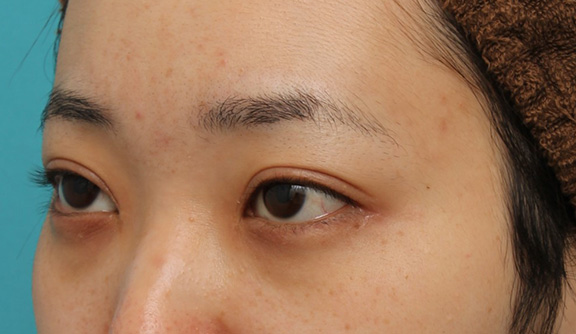 症例写真,二重まぶた切開法で作られた幅広平行型二重を狭く修正手術した症例写真,After(修正手術後8ヶ月後),ba_eye_modify022_b03.jpg
