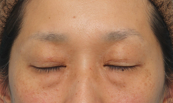症例写真,眼瞼下垂手術でまぶたの開きを良くし、自然な二重まぶたを作った症例写真,After(6ヶ月後の目を閉じた状態),