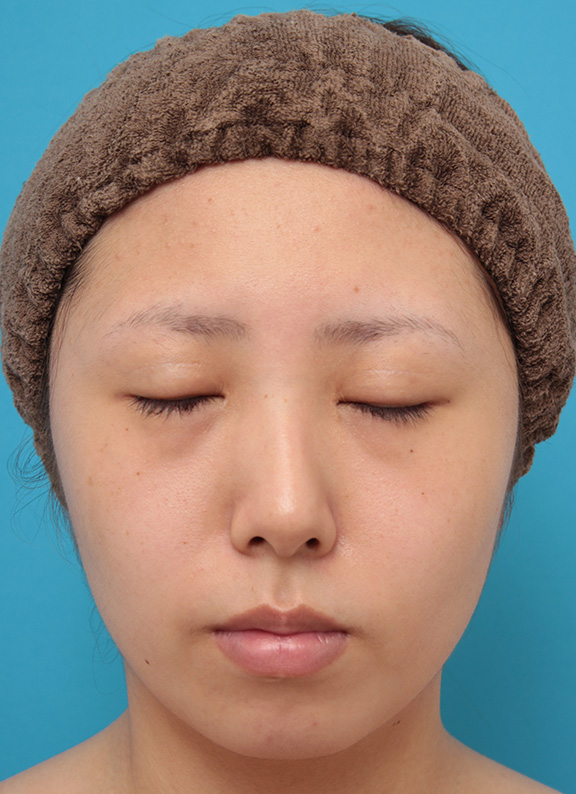 二重まぶた・全切開法,患者様の希望で超幅広平行型二重を全切開法で行い、同時に目頭切開、目尻切開、タレ目形成を行った症例写真,After(6ヶ月後),ba_sekkai061_b02.jpg