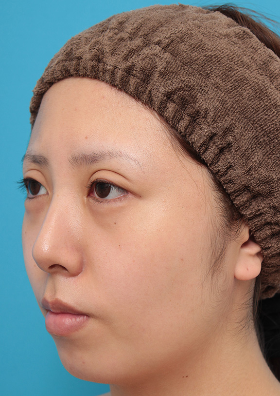 二重まぶた・全切開法,患者様の希望で超幅広平行型二重を全切開法で行い、同時に目頭切開、目尻切開、タレ目形成を行った症例写真,After(6ヶ月後),ba_sekkai061_b04.jpg