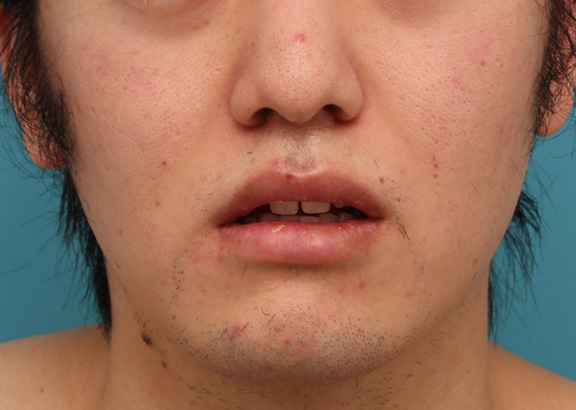 症例写真,明らかに厚い唇を手術で薄くして平均サイズくらいにした20代男性の症例写真,After(6ヶ月後),ba_usuku010_b02.jpg