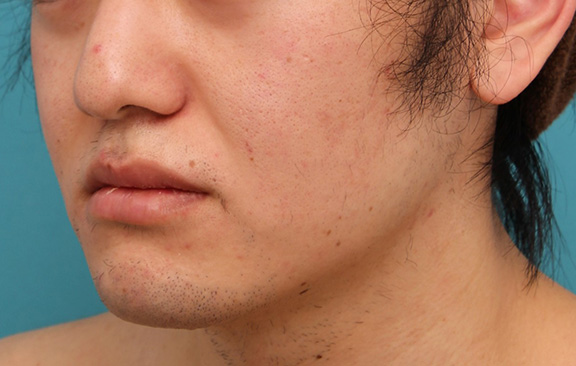 症例写真,明らかに厚い唇を手術で薄くして平均サイズくらいにした20代男性の症例写真,After(6ヶ月後),ba_usuku010_b03.jpg