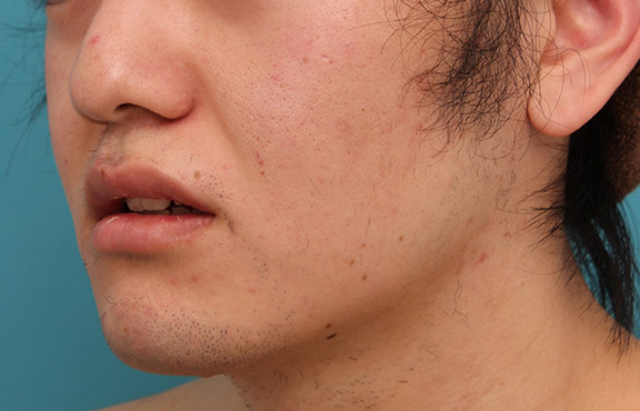 症例写真,明らかに厚い唇を手術で薄くして平均サイズくらいにした20代男性の症例写真,After(6ヶ月後),ba_usuku010_b04.jpg