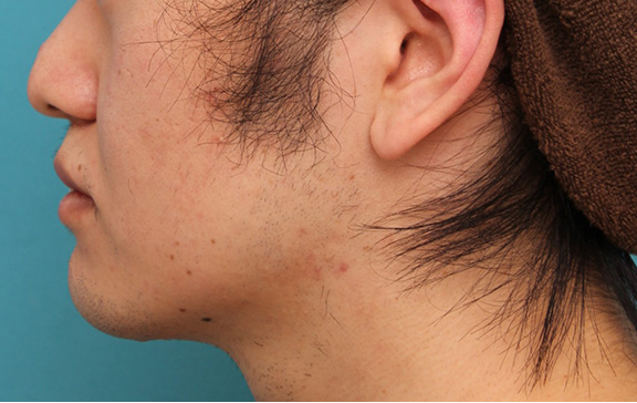 症例写真,明らかに厚い唇を手術で薄くして平均サイズくらいにした20代男性の症例写真,After(6ヶ月後),ba_usuku010_b05.jpg