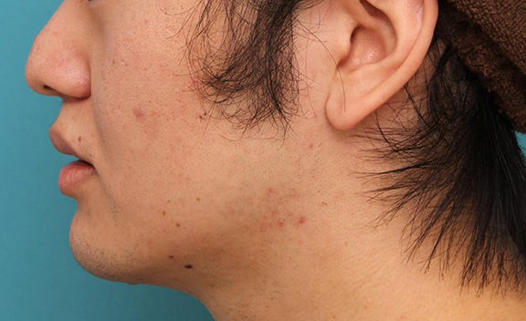 症例写真,明らかに厚い唇を手術で薄くして平均サイズくらいにした20代男性の症例写真,After(6ヶ月後),ba_usuku010_a06.jpg