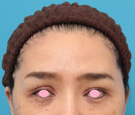 症例写真,髪の毛の生え際で切開する額リフトでおでこのシワを伸ばした症例写真,After(6ヶ月後の化粧をした状態),ba_hitailift003_b03.jpg