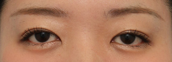 症例写真,20代女性に全切開二重術を行い、自然な末広形の二重にした症例写真,After( 6ヶ月後メイクあり),