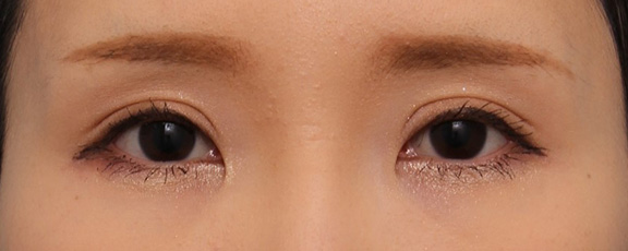 症例写真,20代女性に全切開二重術を行い、幅広の平行二重にした症例写真,After( 6ヶ月後メイクあり),