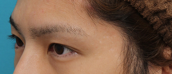 二重まぶた・全切開法,二重全切開法の症例写真,After(3ヶ月後),ba_sekkai064_b02.jpg