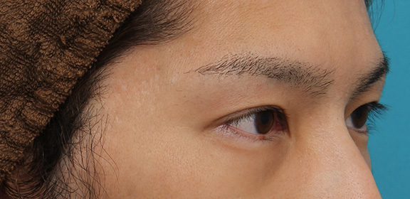 二重まぶた・全切開法,二重全切開法の症例写真,After(3ヶ月後),ba_sekkai064_b03.jpg