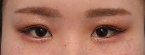 症例写真,20代女性に埋没2針固定を行い、自然な平行二重にした症例写真,After( 3ヶ月後メイクあり),