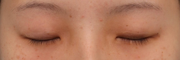 症例写真,10代女性に埋没2針固定を行い、ナチュラルな平行二重にした症例写真,After（3ヶ月後目を閉じた状態）,