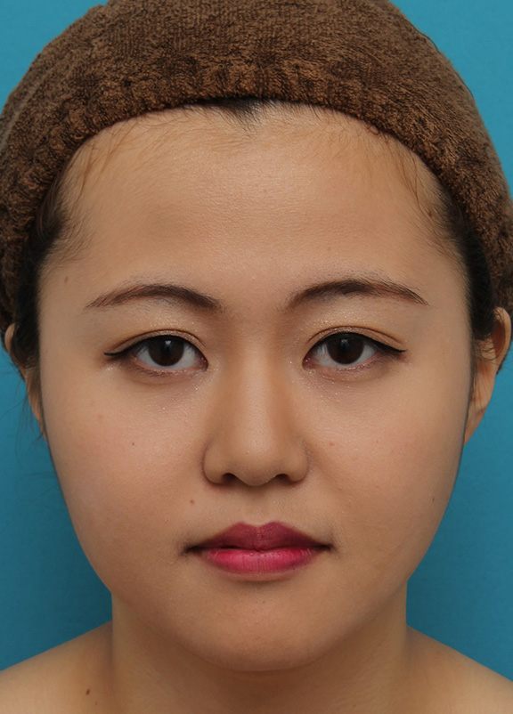 症例写真,10代女性に埋没2針固定を行い、幅広めの平行二重にした症例写真,After(3ヶ月後メイクあり),