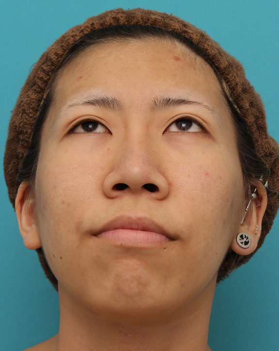 鼻尖形成(鼻尖縮小・だんご鼻修正),20代女性の、総合的なお鼻のお悩みを手術で改善した症例写真,After(6ヶ月後メイクなし),ba_ryubi1052_b04.jpg