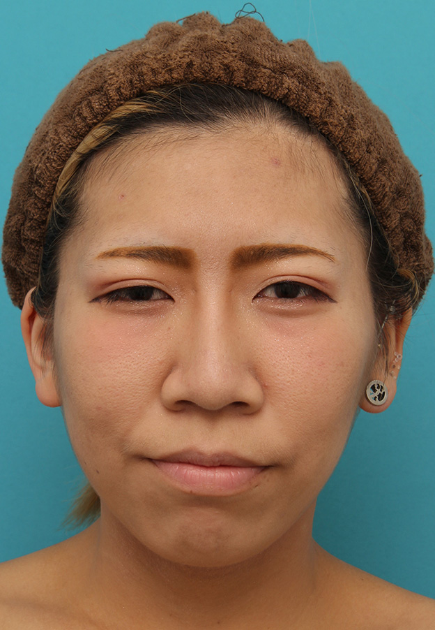 鼻尖形成(鼻尖縮小・だんご鼻修正),20代女性の、総合的なお鼻のお悩みを手術で改善した症例写真,After(6ヶ月後メイクあり),